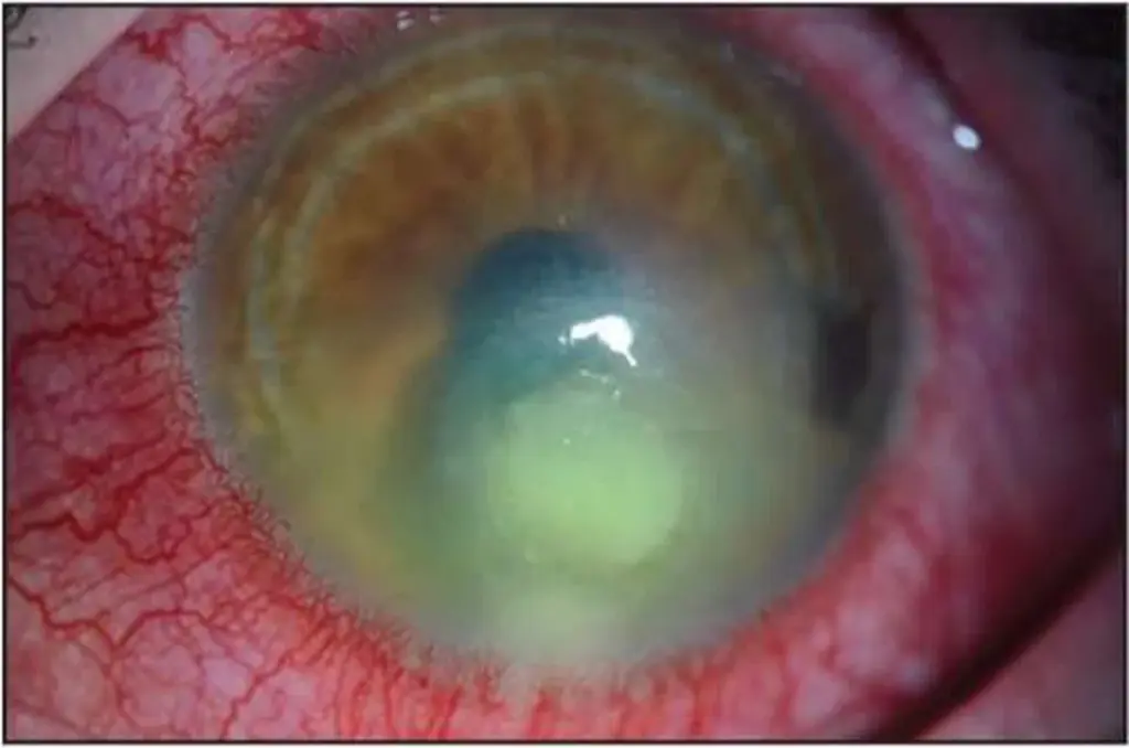 Optometristé varují: nikdy nedělejte tuto běžnou chybu při používání kontaktních čoček.