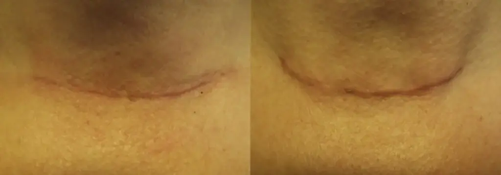 Med na jizvy? Proč lékaři uznávají tento starověký trik.