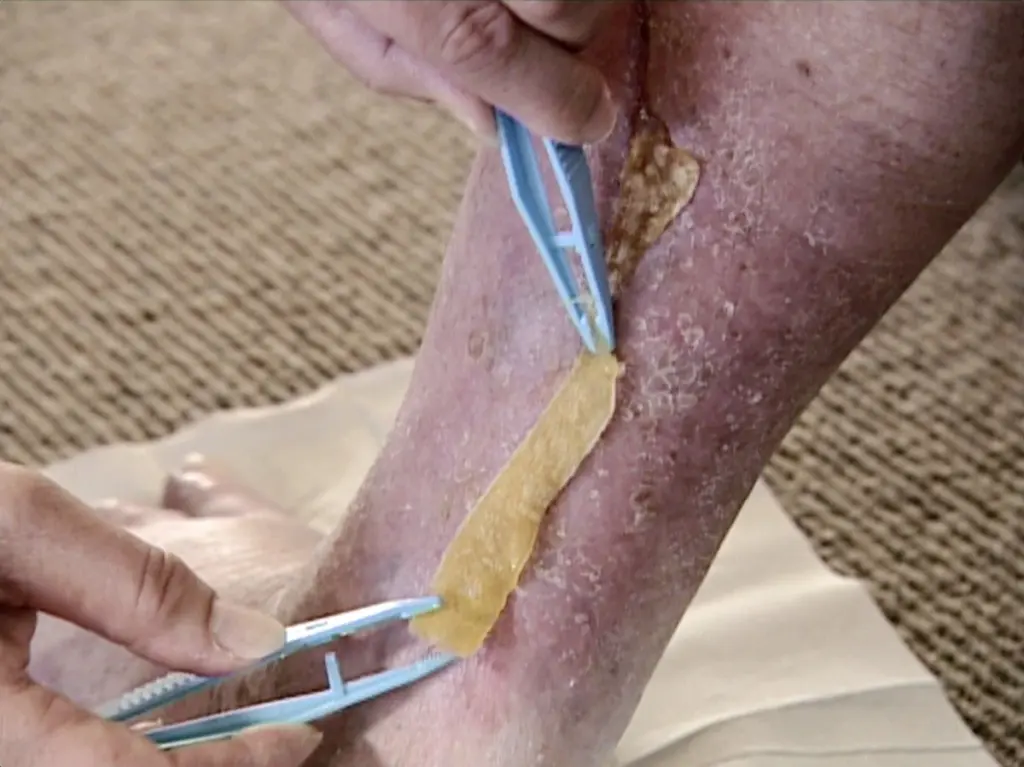 Med na popáleniny? Proč hojí rány rychleji než drahé krémy.